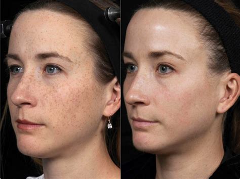 Fractional Laser Treatment in Singapore: Before, During & After.
